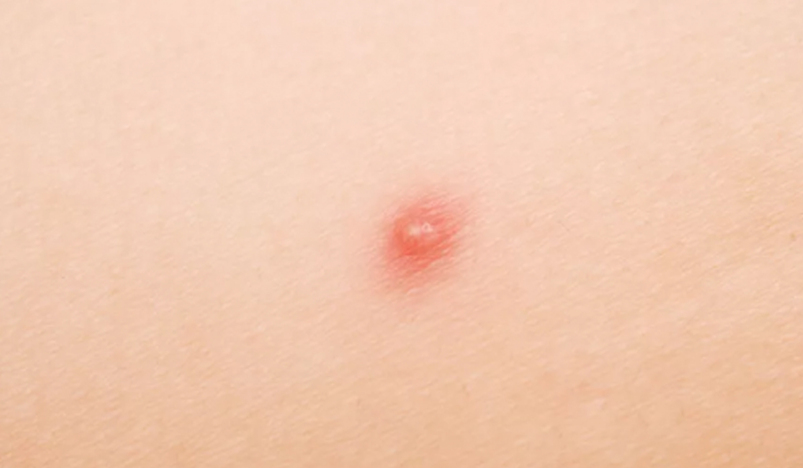 Is petechiae a symptom of leukemia?